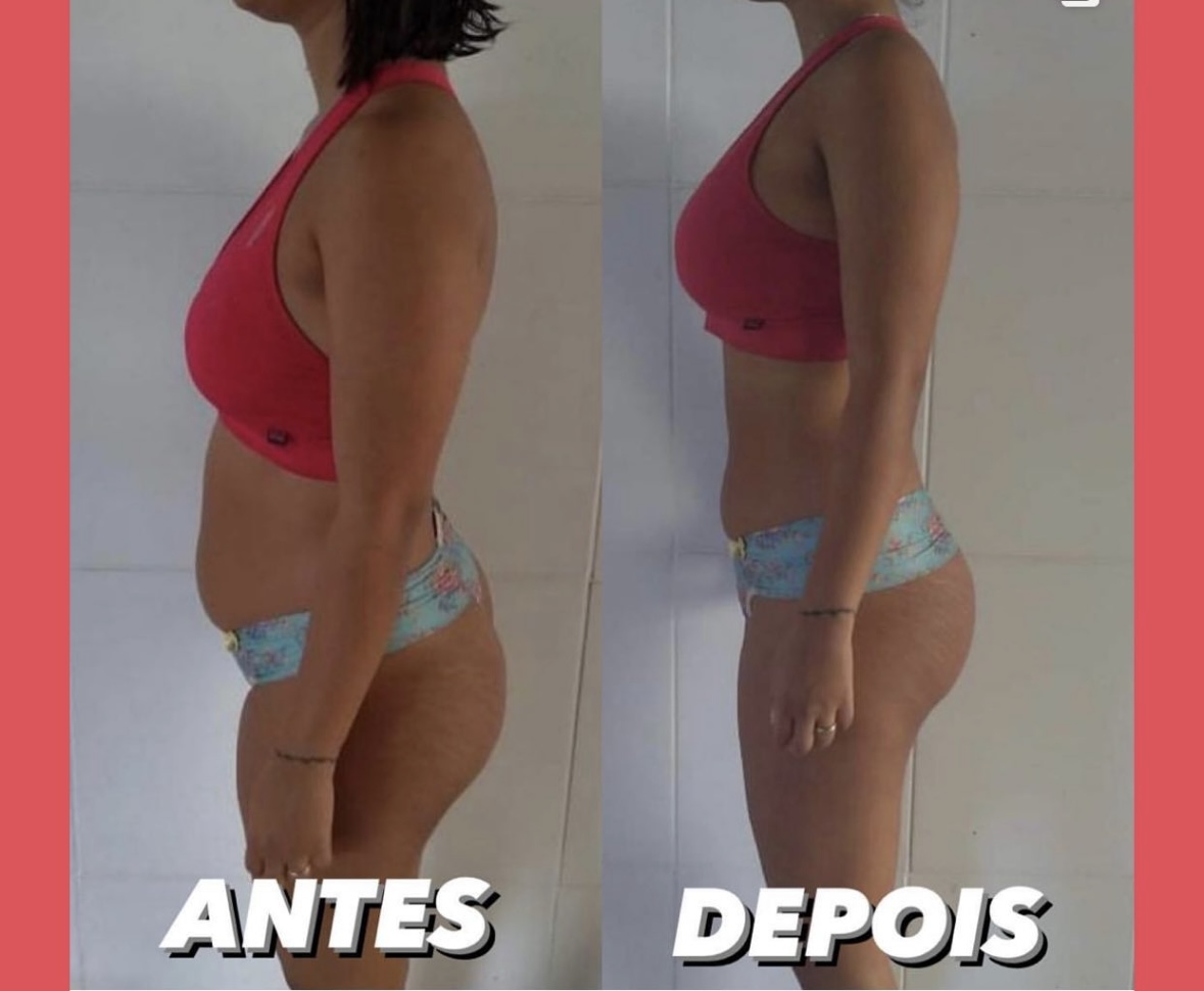 Resultado Aluna - Redução Abdominal